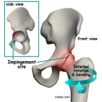 hip_FAI_causes01 | EDGE Physical Therapy in Omaha, Papillion, NE